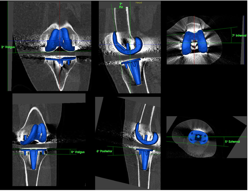 Fig. 2 Determination of tibial and femoral total knee arthroplasty (TKA) component position (varus–valgus, flexion–extension, internal rotation–external rotation) on 3D-CT using customised software after reorientation in relation to the mechanical axis and definition of anatomical landmarks on the bone surface (OrthoImagingSolutions, London, UK)
