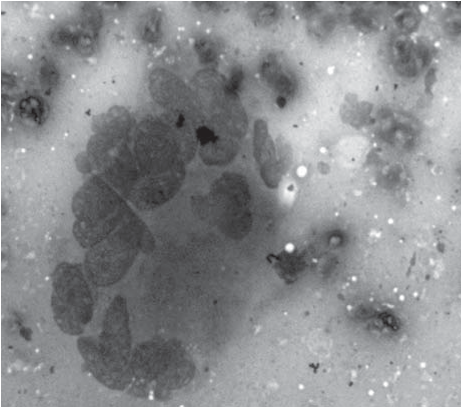 Fig. 5: Showing Granuloma with Clusters of Epitheloid Cells, Lymphocytes.