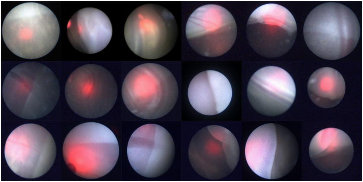 Figure 1: Sample frames from our dataset. The frames are extracted from intra-operative videos acquired in the actual surgical practice for Twin-to-Twin Transfusion Syndrome (TTTS). Each frame refers to a different video. Although video acquisition was performed with the same equipment, the frames present high variability, in terms of: (i) different membrane position, shape, tissue area in the field of view, contrast and texture, (ii) noise and blur, (iii) presence of amniotic fluid particles, (iv) vessels along the membrane equator, (v) different levels of illumination, (vi) presence of laser-guide light.