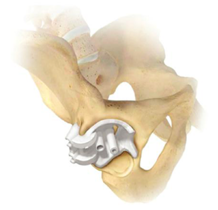 Figure 3: Image showing the Signature Hip system (Zimmer Biomet). The 3D printed Primary Acetabular Guide is seated into the acetabulum, and pins are placed into the rim of the acetabulum through attached drill sleeves. The pins are left in place, and the guide is removed. These pins can act as either a constrained or nonconstrained guide to reaming of the acetabulum and placement of the implant. (Courtesy of Zimmer Biomet, Warsaw, IN.)