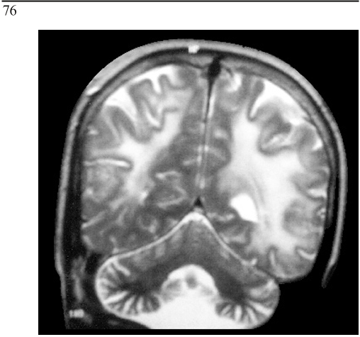 Figure 4. T2 weighted MRI showing increased signal in the parieto-occipital white matter and grey matter.