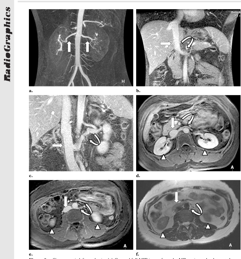 Figure 9. Circumaortic left renal vein. (a) Coronal full MIP image from the MR angiography data set shows one renal artery bilaterally (arrows). (b) Coronal targeted MIP image of the venous phase shows the superior leg of a circumaortic left renal vein (curved arrow) draining into the IVC (straight arrow). (c) Coronal targeted MIP image of the venous phase obtained slightly posterior shows the inferior leg of the circumaortic renal vein (curved arrow) draining into the IVC (straight arrow). (d) Axial delayed gadolinium-enhanced 3D fast GRE image obtained with fat saturation at the level of the midpoles of the kidneys (arrowheads) shows the superior leg of the circumaortic renal vein (curved arrow) draining into the IVC (straight arrow). (e) Axial delayed gadolinium-enhanced 3D fast GRE image obtained with fat saturation at the level of the lower poles of the kidneys (arrowheads) shows the inferior leg of the circumaortic renal vein (curved arrow) crossing behind the aorta and draining into the IVC (straight arrow). (f ) Axial single-shot fast SE image obtained at the level of the lower poles of the kidneys (arrowheads) shows the inferior leg of the circumaortic renal vein (curved arrow), which appears as an area of signal void, crossing behind the aorta and draining into the IVC (straight arrow).
